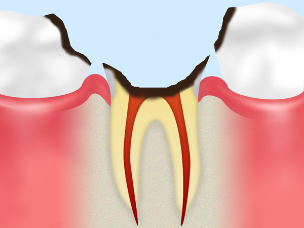 C4　歯根の虫歯