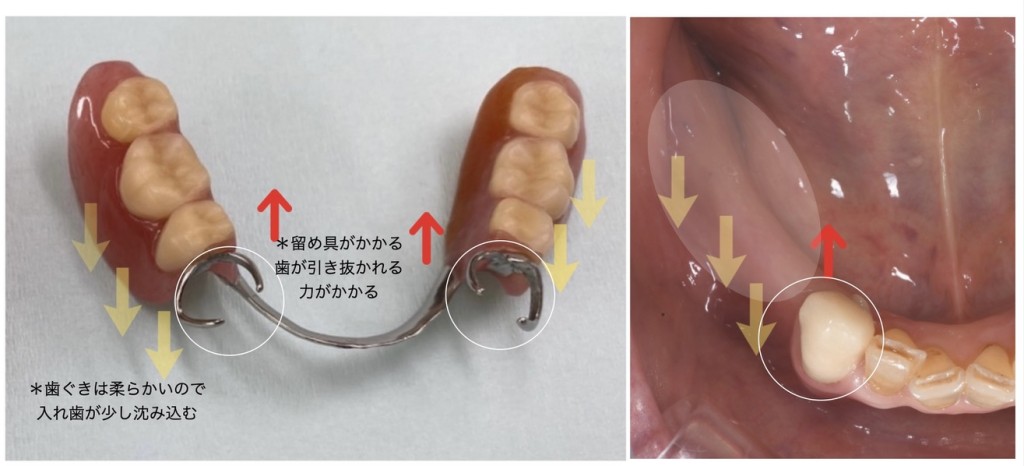 長く使える入れ歯の7つの秘訣｜河内長野市｜TASK歯科・矯正歯科