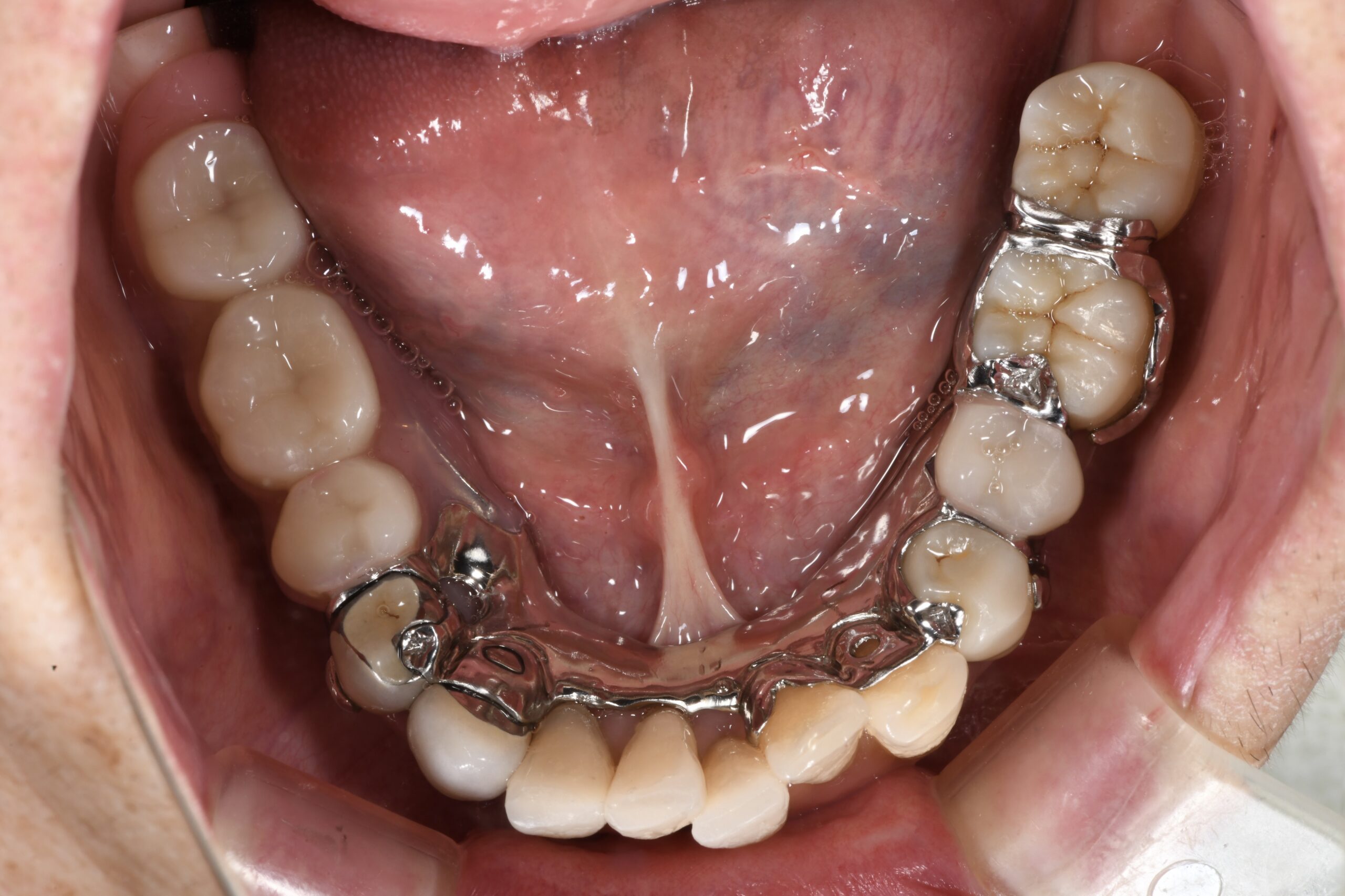 年齢的にインプラントが追加でできない方によく噛める入れ歯を作成した事例
