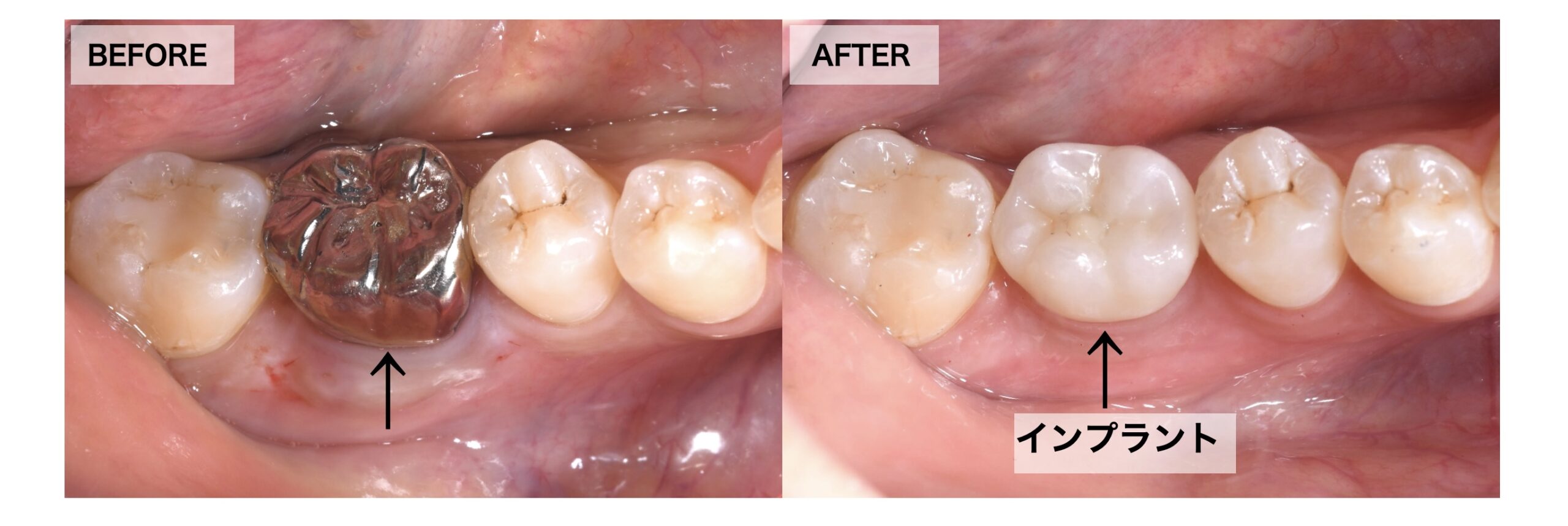 【症例解説】右下6番の根破折｜インプラントが歯を守る治療になった理由