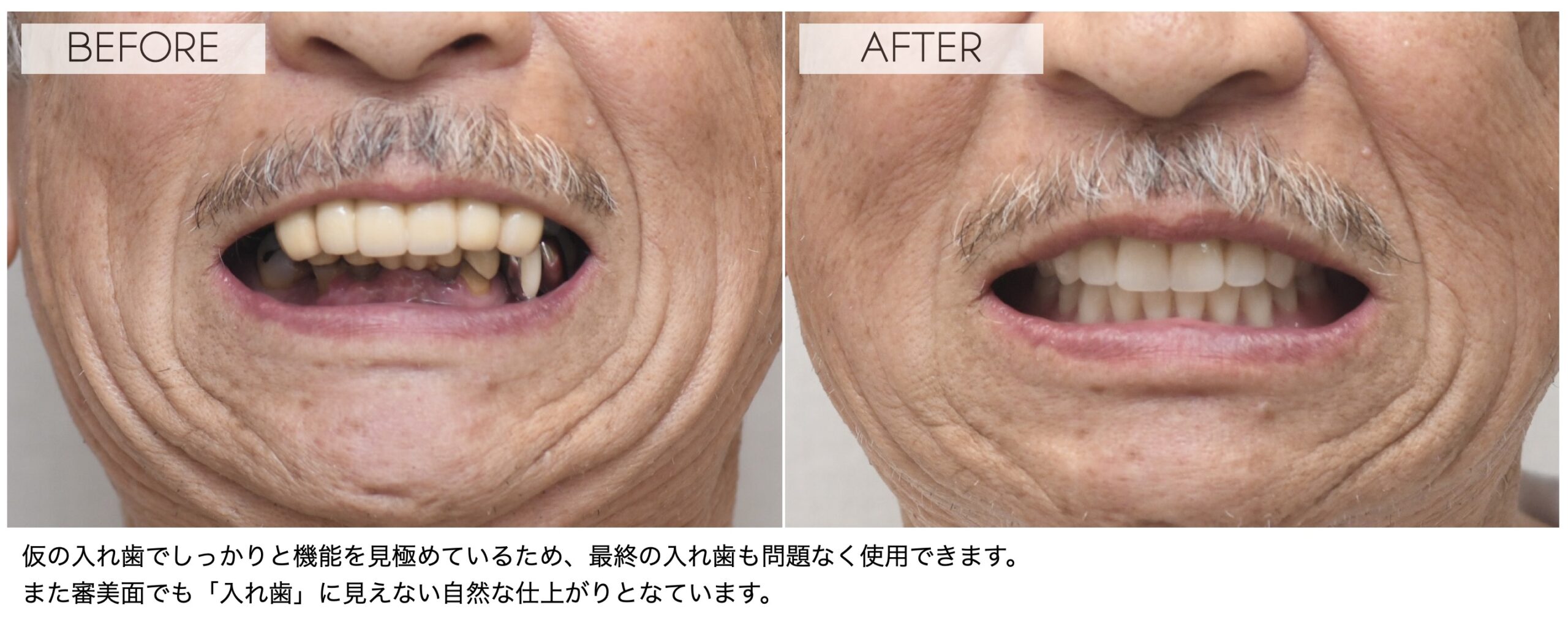 重度歯周病で歯がグラグラ…72歳男性が入れ歯でしっかり噛めるようになった症例